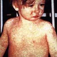 2019 Measles Outbreak