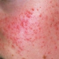 Getting acne